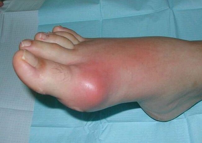 Klinička slika artritisa stopala - otok i upala