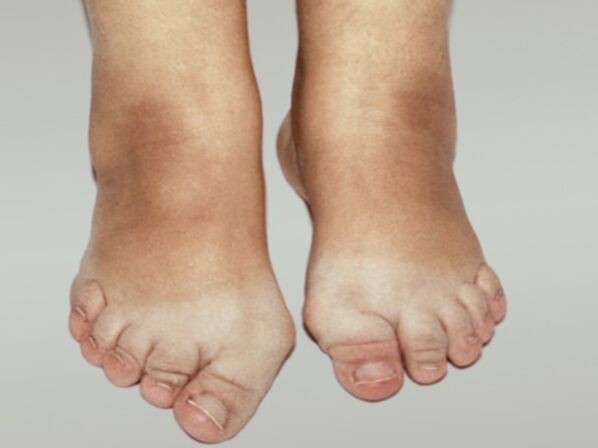 Osteoartritis stopala s teškom deformacijom prstiju