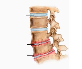 Osteohondroza