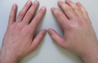 artralgija kao uzrok bolova u zglobovima prstiju