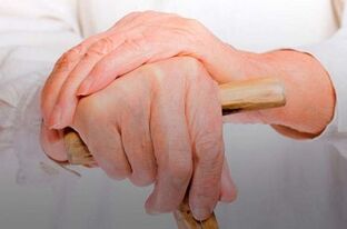 bolovi u zglobovima prstiju s reumatoidnim artritisom