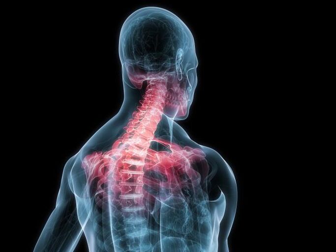 osteohondroza vratne kralježnice modifikacija je intervertebralnih hrskavičnih diskova