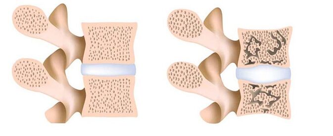 osteoporoza - uklanjanje kalcija iz kostiju