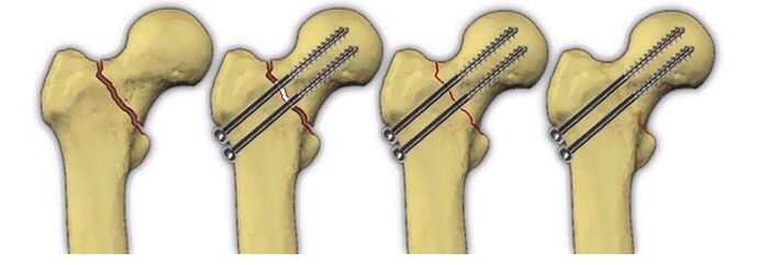 fiksacija tijela kosti klinovima za bol u zglobu kuka