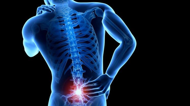 bol u leđima s lumbalnom osteohondrozom
